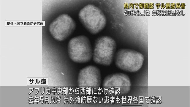 画像: 静岡県初…40代男性が「サル痘」に感染 海外渡航歴なく状態は安定 youtu.be
